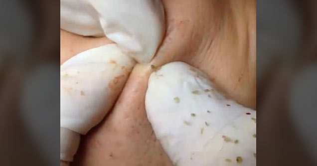 man wearing white gloves popping pimples