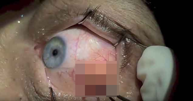 This Eye Ball Cyst Removal Is A Thing Of Beauty