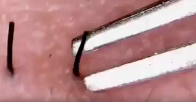 watch this super close up ingrown hair removal video