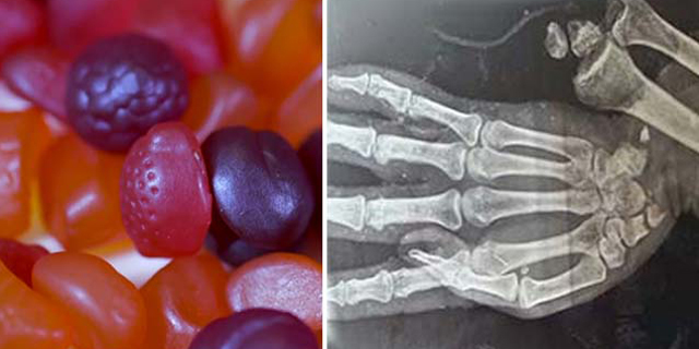 Boy Ate 150 Gummy Vitamins For Breakfast A Boy Ate 150 Gummy Vitamins For Breakfast. This Is What Happened To