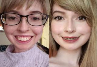 a woman before and after upper jaw surgery | cool transformation, transformations, body transformations a woman before and after upper jaw surgery | cool transformation, transformations, body transformations