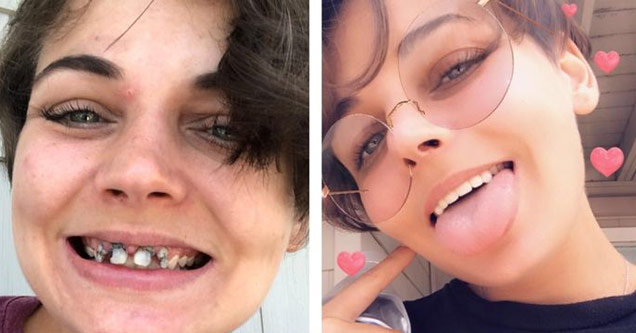 a woman before and after getting her teeth fixed