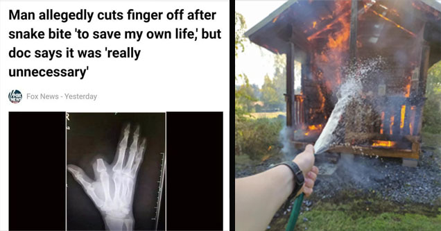 x ray of missing finger, burning shed