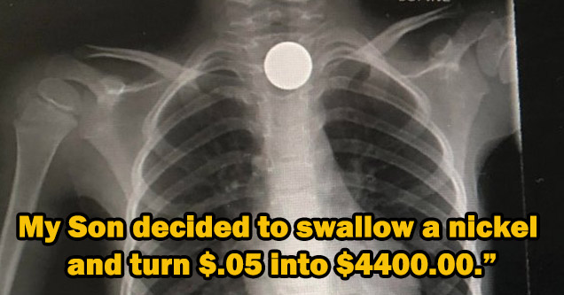 an x-ray of a kid who swallowed a nickel