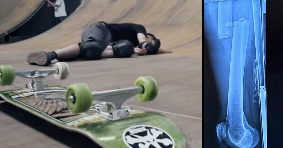 tony hawk fall and xray