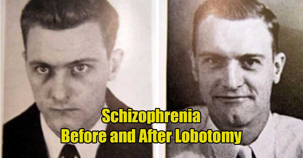 Fascinating Photos, Schizophrenia before and after