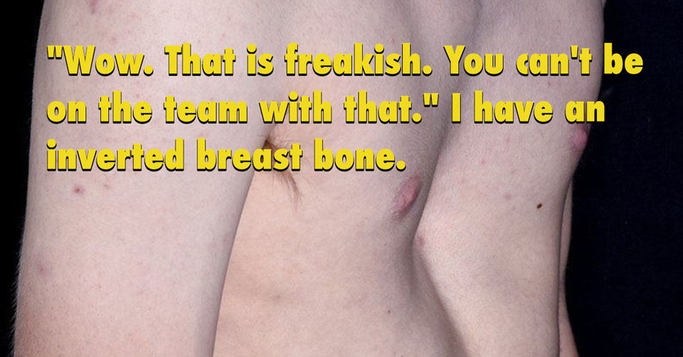 inverted breast bone advice