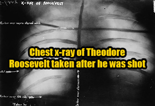 chest x-ray of theodore Roosevelt chest after he was shot