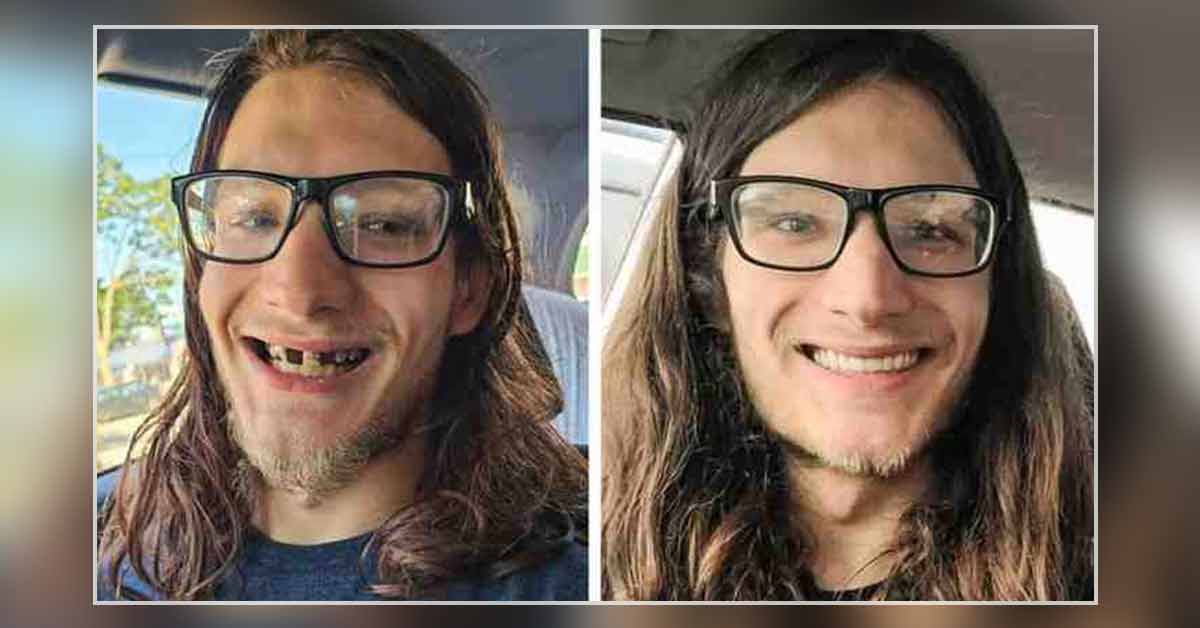 a guy before and after getting his teeth fixed