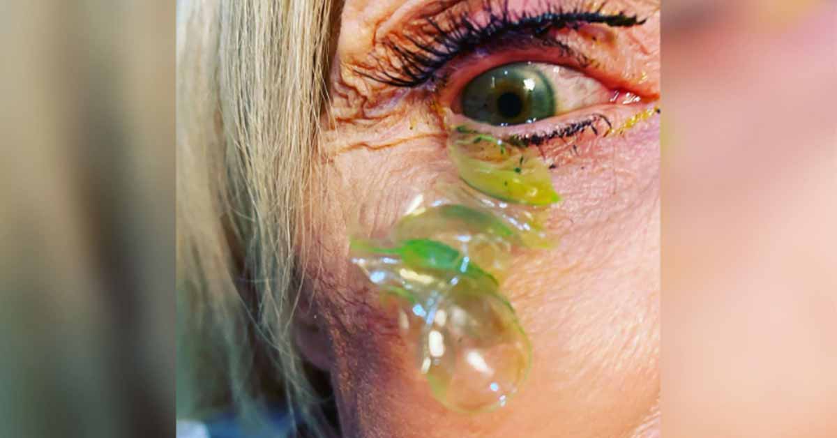 woman has 23 contact lenses removed from her eye