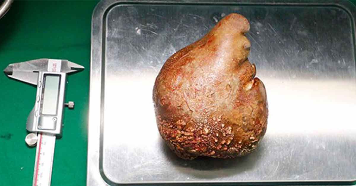 woman sets world record passing a kidney stone that weighted four hamsters