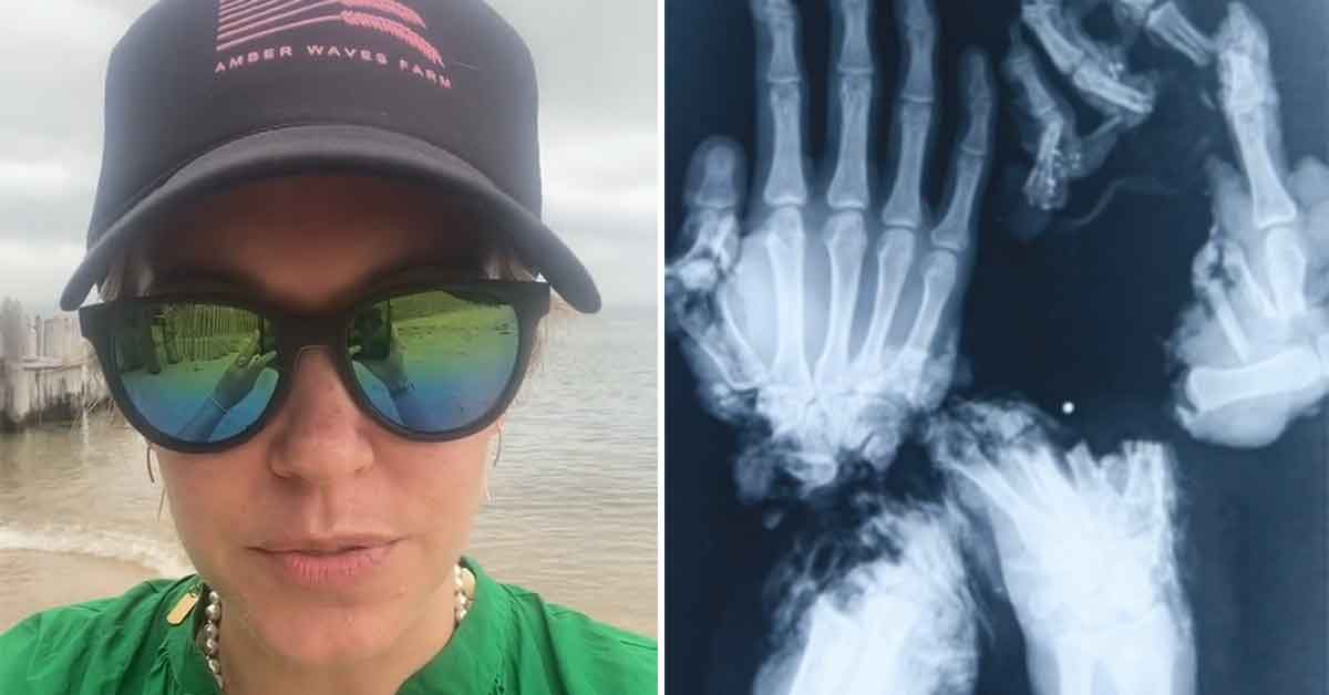 hand surgeon shares graphic pics of fourth of july fails