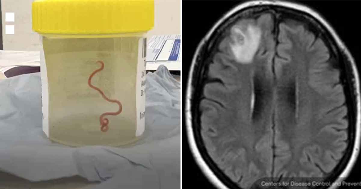 Live Worm Yanked From Woman’s Brain in Surgical First