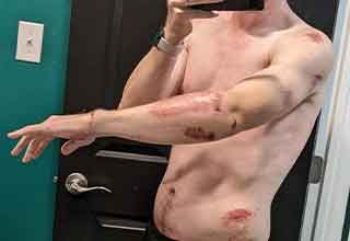 <p>These ones are going to leave a mark, and there are plenty of photos to prove it.&nbsp;</p><p><br></p><p>There's something about the human experiences that has to look when someone else gets hurt. There's a reason rubbernecking causes so much extra traffic. It's a way for us to imagine how much worse things could be, and therefore feel better about our current situations. These are 23 photos of accidents that HAD to hurt, and the marks to prove it.&nbsp;</p>