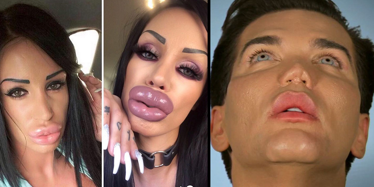 19 Disturbing Times People Took Plastic Surgery Too Far
