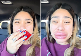 Woman Winds Up With Hugely Swollen Lips After Allergic Reaction to Lip Filler Removal
