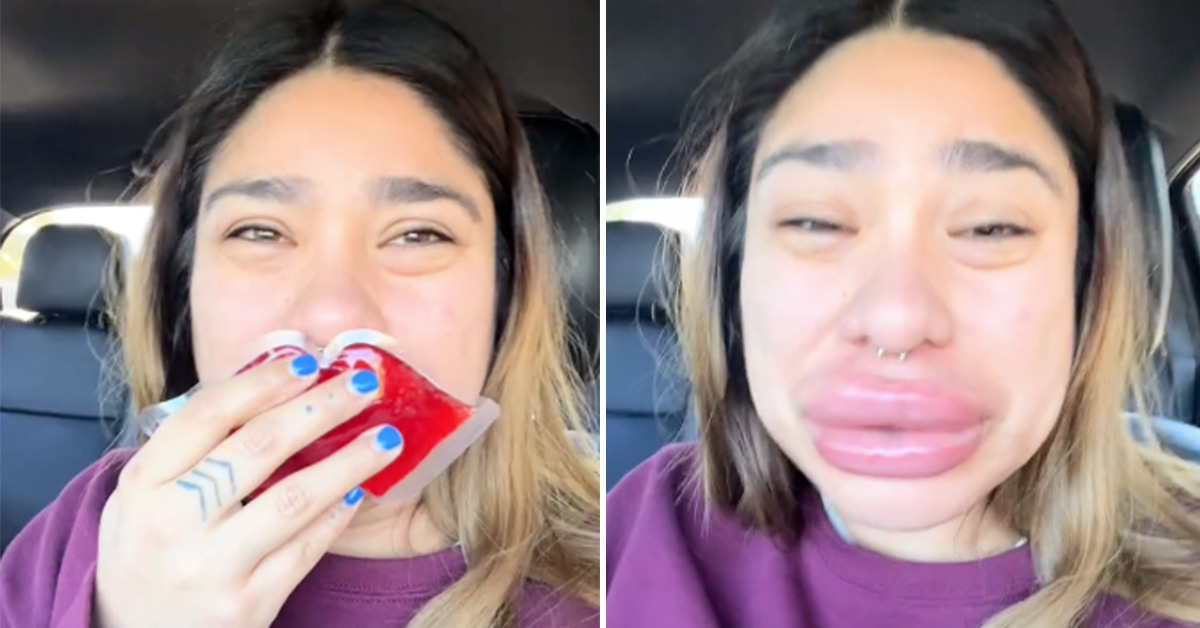 Woman Winds Up With Hugely Swollen Lips After Allergic Reaction to Lip Filler Removal