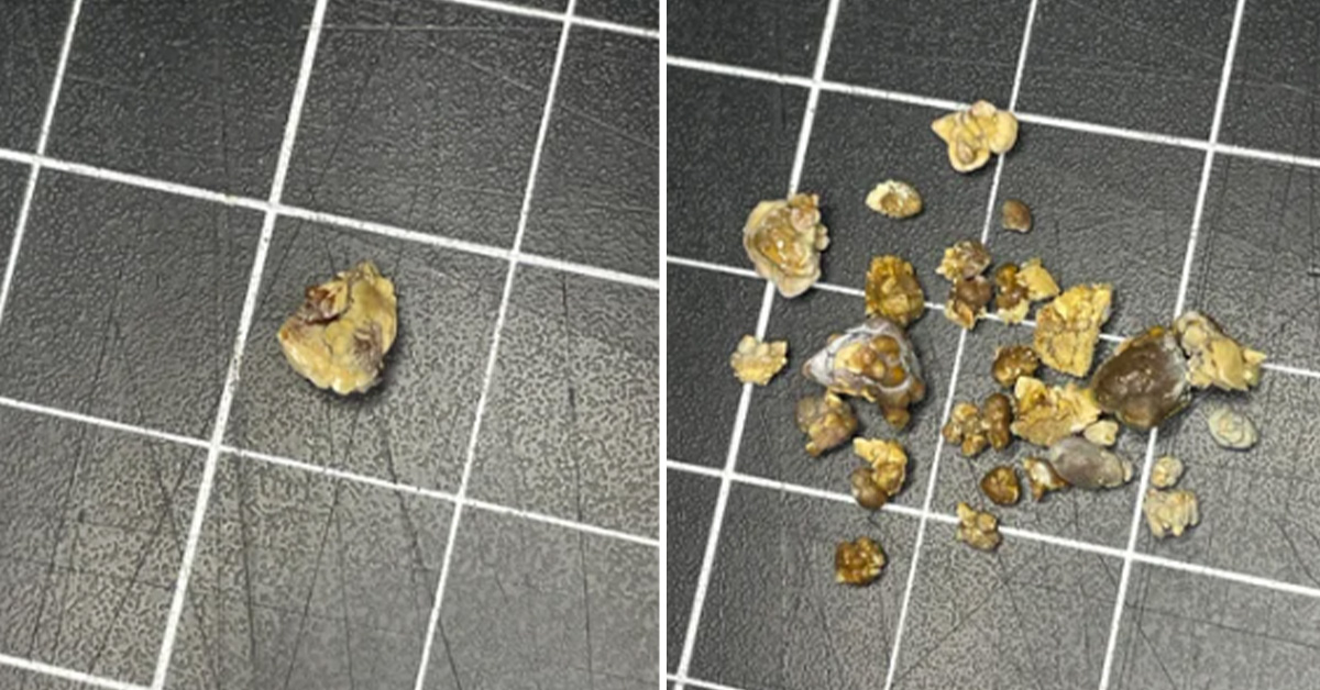 Dude Shows Off His Kidney Stone Collection to Collective Disgust