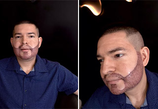 Men Are Getting Beard Transplants, and It’s Terrifying