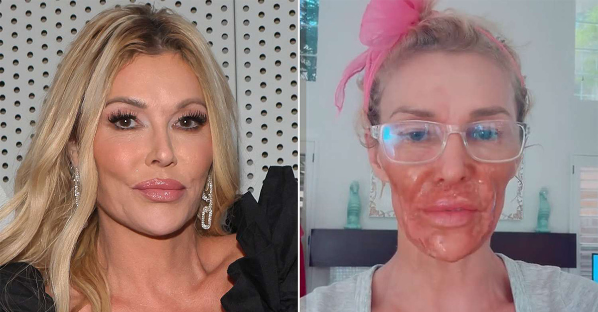A Real Housewife Tried to Remove Her Face Parasite With Nair, and It Didn’t Go Well