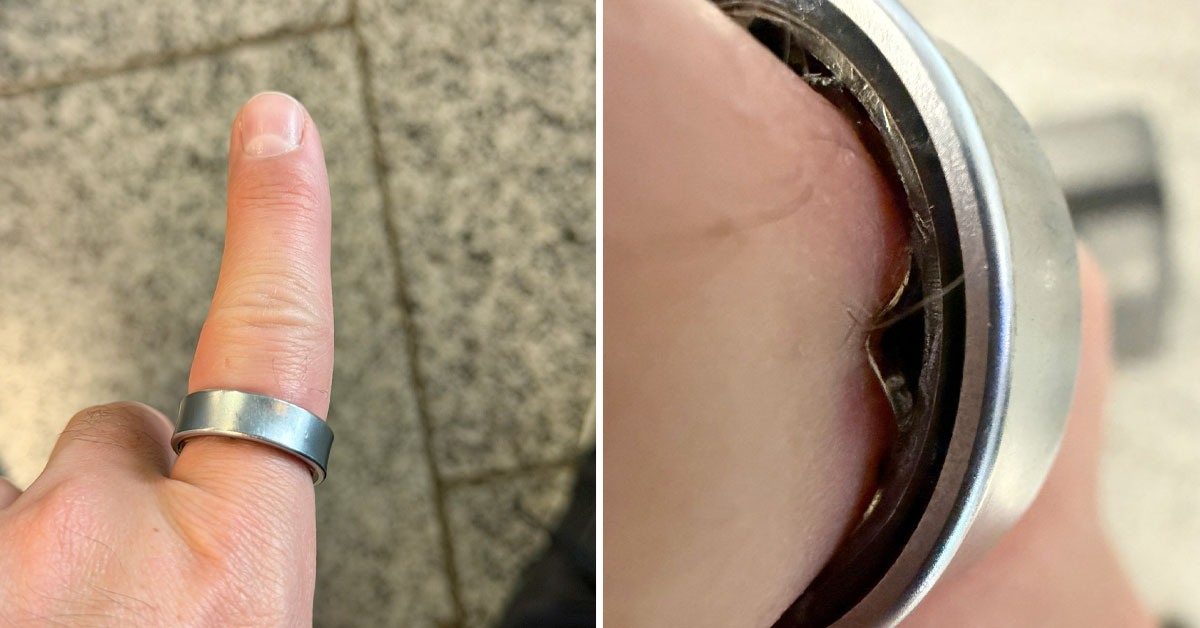 ‘Smart Rings’ Are Swelling and Getting Stuck on People’s Fingers