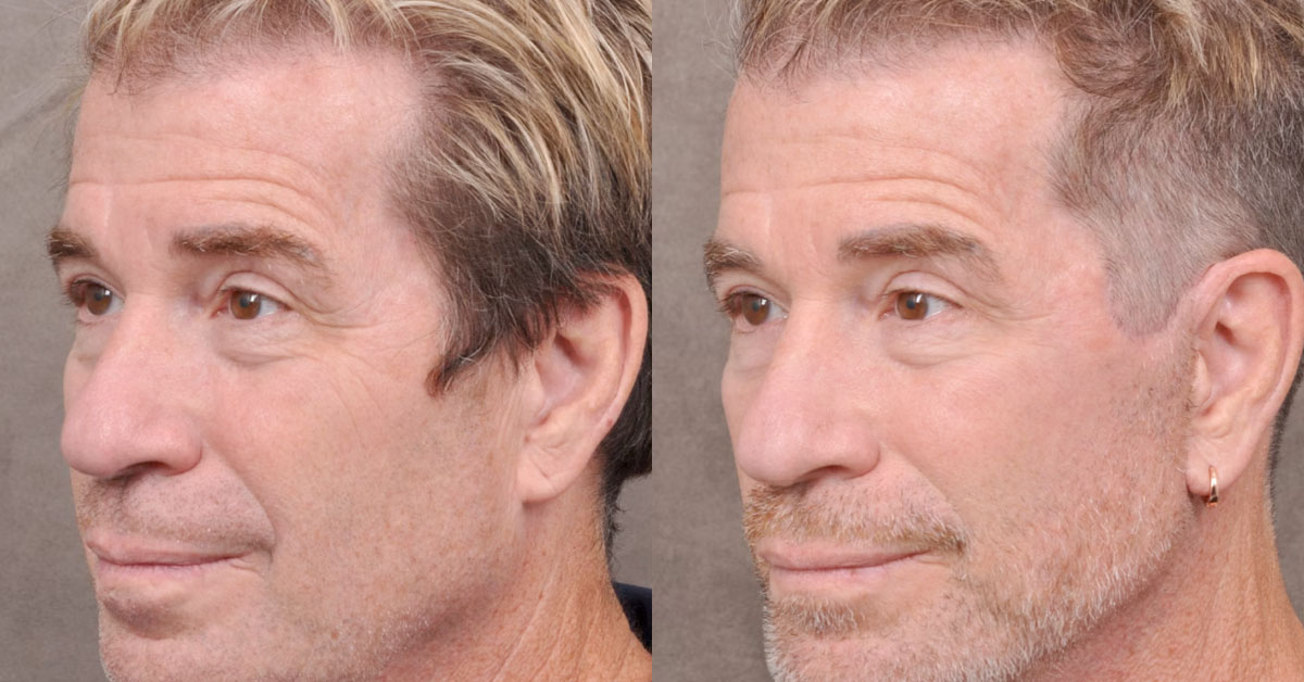 Silicon Valley Tech Bros Are Getting Facelifts So VCs Think They’re Still ‘Young Founders’