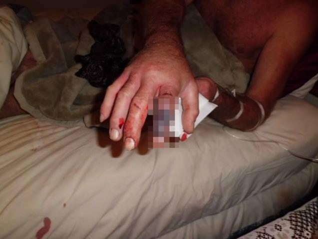 Western Diamondback Rattlesnake Bite Progression