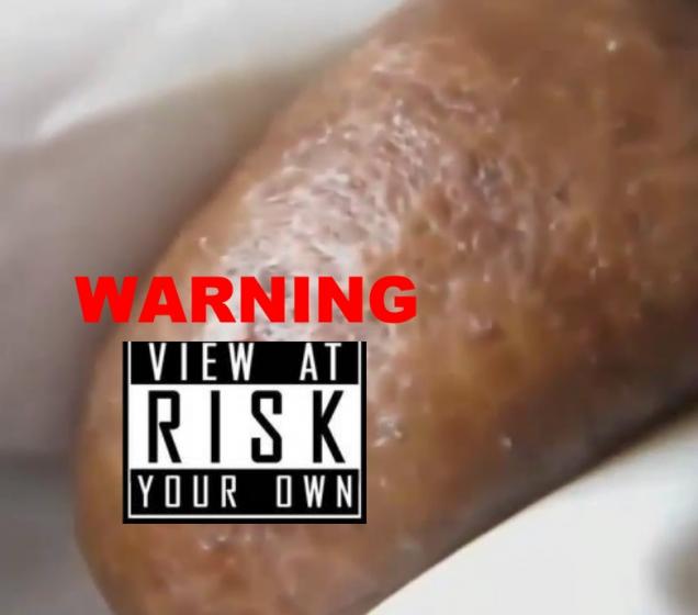 The Neverending Zit - Eww Video | eBaum's World