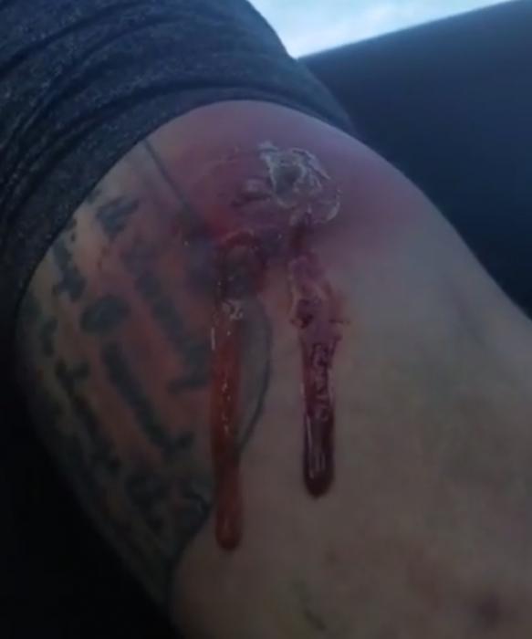 Massive Boil Explosion Will Make You Lose Your Appetite