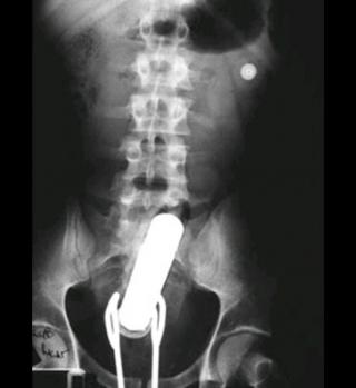 Objects Found In People