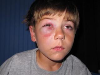 Progression Of A Black Eye