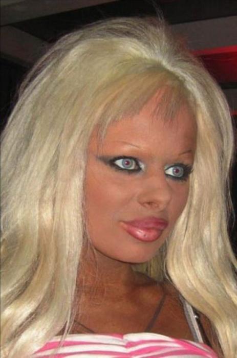 30 Horrifying Results of Terrible Plastic Surgery