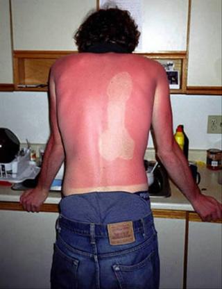 Funny sunburns