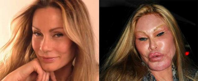 21 Celebrities With Botched Plastic Surgery Eww Gallery Ebaums World 8383