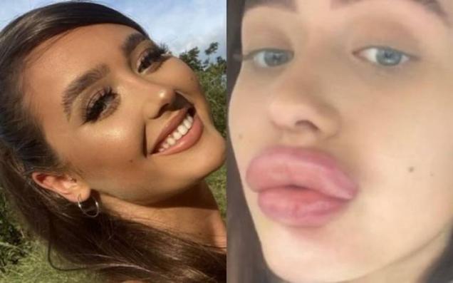 This Girl Just Wanted Bigger Lips, the Results Were Horrible.