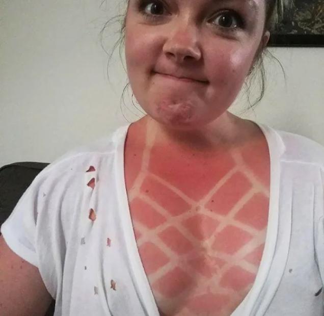 28 Sunburns That Are Really Painful.