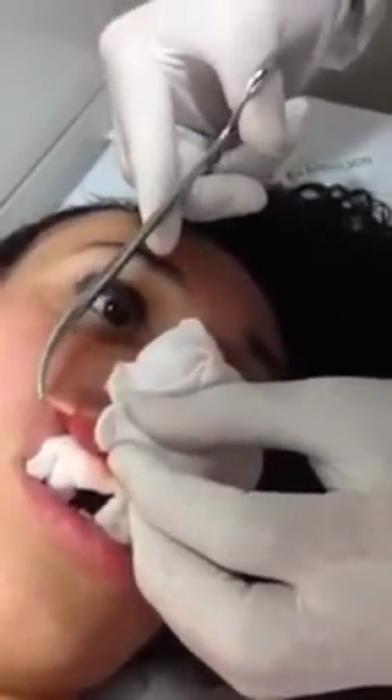 Girl Has a Giant Worm Larvae Extracted From Her Lip