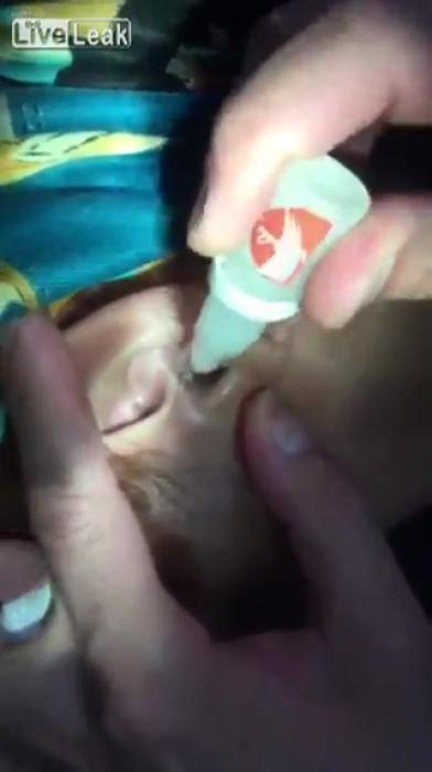 Removing a centipede from a girl's ear