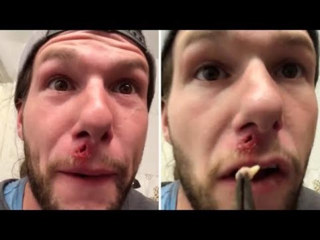 Guy Takes It Upon Himself To Remove Growth In His Upper Lip
