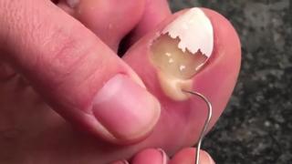 Man Gets Extremely Happy To Pop His Puss Toe