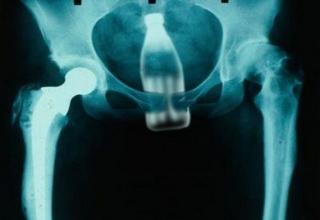 Funny pictures compiled by doctors of people who have come to have things removed from various bodily cavities.