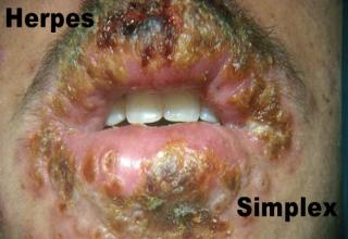 Some caused by STDS