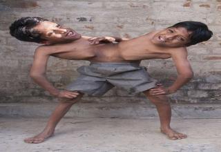 Conjoined twins Shivanath and Shivram Sahu were born in a tiny village near Raipur in central India. Their arrival caused quite a stir with some villagers even worshipping them as divine incarnations...
