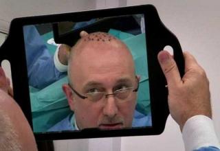 Graham Ryder, 51, was left with a cluster of deep scars across the top of his head following an attempted hair transplant, and electrolysis in an attempt to fix it...