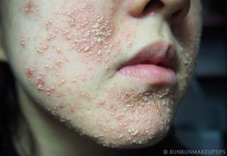 photos of people having extreme allergic reactions