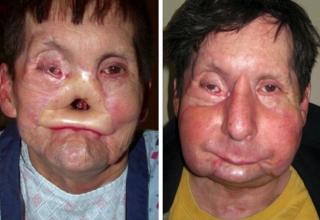 21 Before And After Facial Transplant Images - Wtf Gallery | eBaum's World